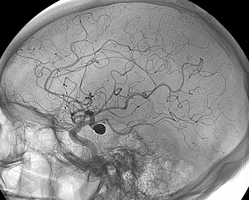 Photo of Interventional Neuroradiology